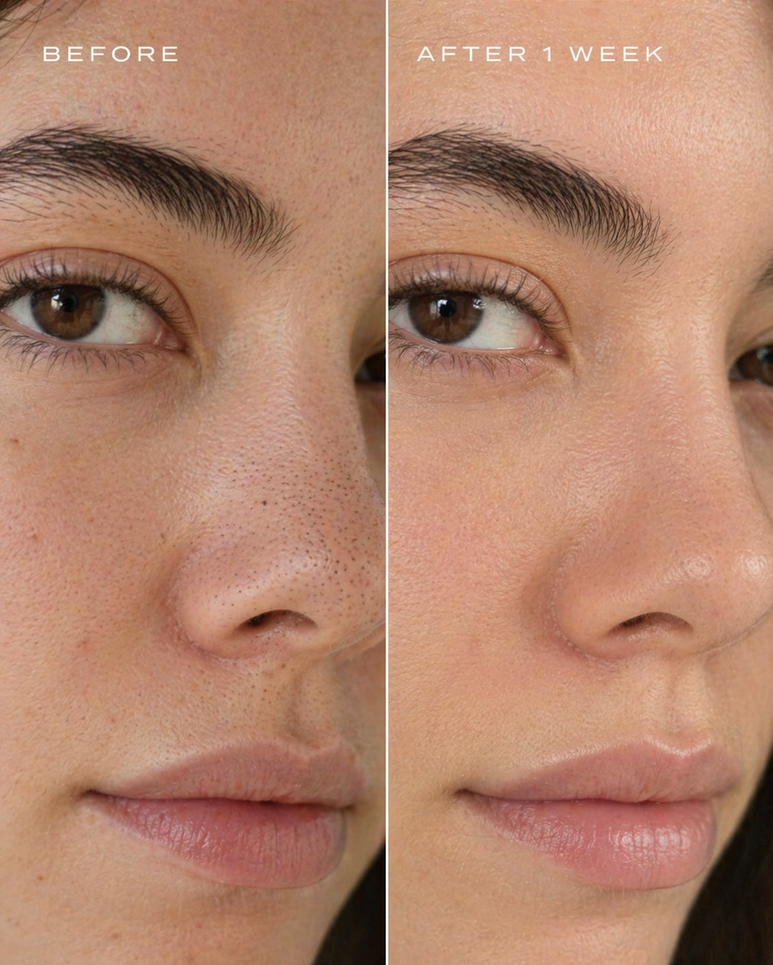 CLEARPORE ™  NOSE PATCHES