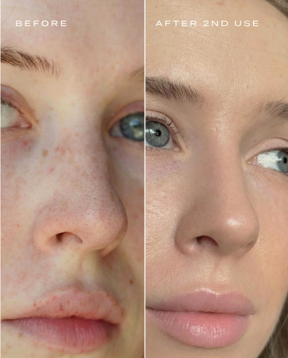 CLEARPORE ™  NOSE PATCHES